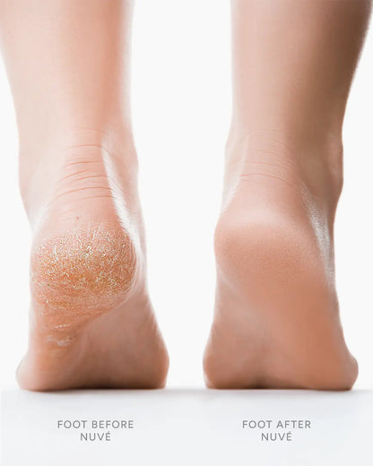 Nuvé Silk 3 Pro | #1 Rated Callus Remover